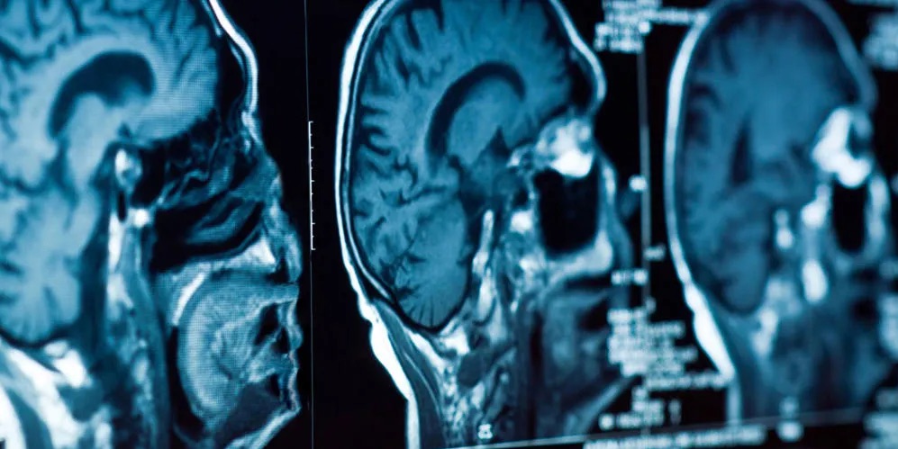 Pictures of several brain scans on a screen